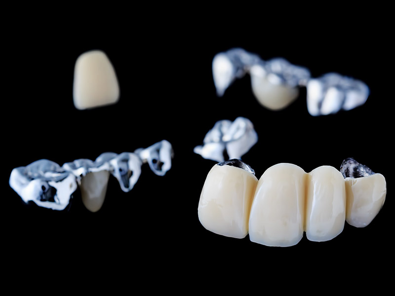 Dental Bridges in Grande Prairie