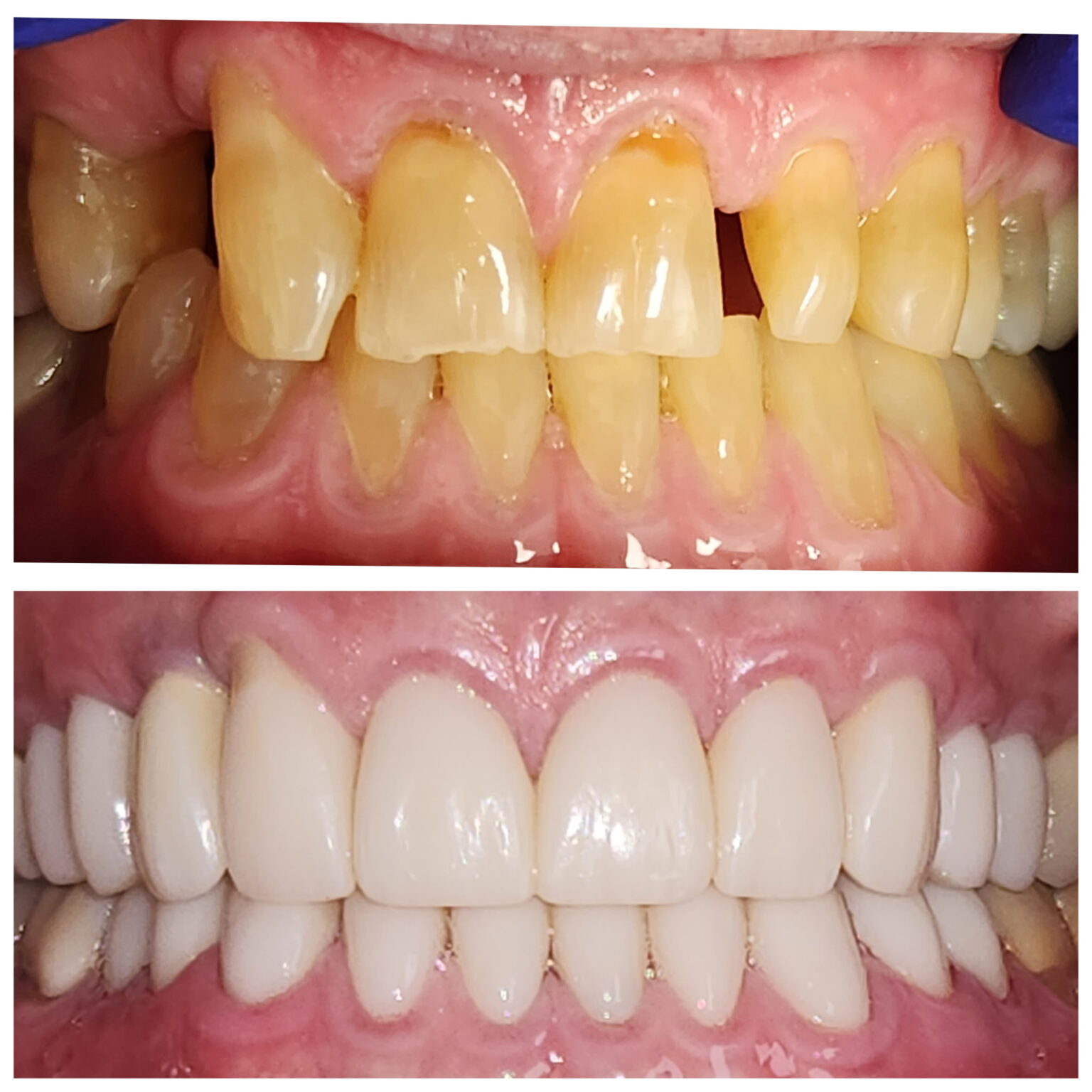 dental crown before after results near you