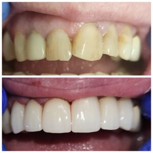 before and after photo of porclain veneers treatment in grande prairie
