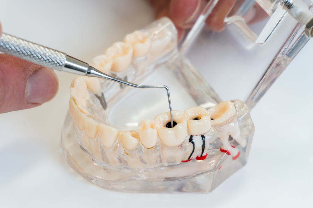 how root canal therapy can save your natural tooth