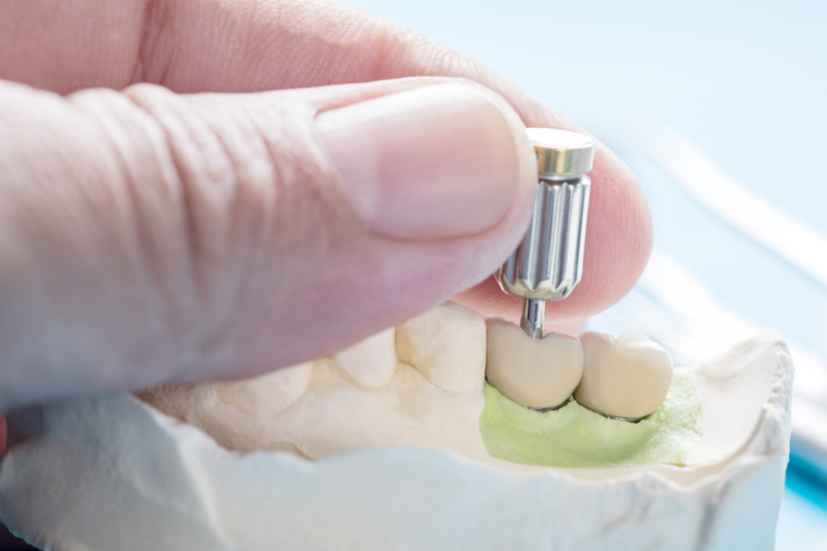 can dental implants replace multiple missing teeth